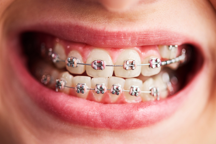 ایمپلنت‌های دندانی و دندان‌های ارتودنسی شده نیاز به مراقبت و رعایت بهداشت دارند.